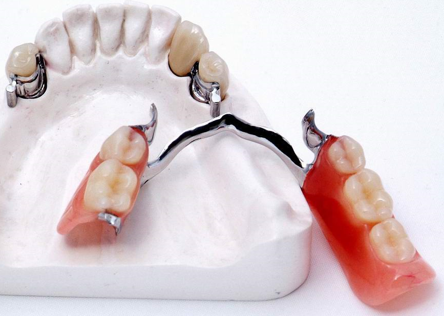 Бюгельный протез на замках верхней. Односторонний бюгельный протез. Бюгельный протез аттачмены. Бюгельный протез замковый (2 замка Bredent). Что такое бюгельный протез в стоматологии.